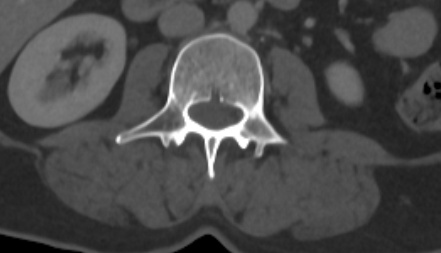 accessory process of vertebrae CT AXIAL   anatomy  image-img-00000-00000