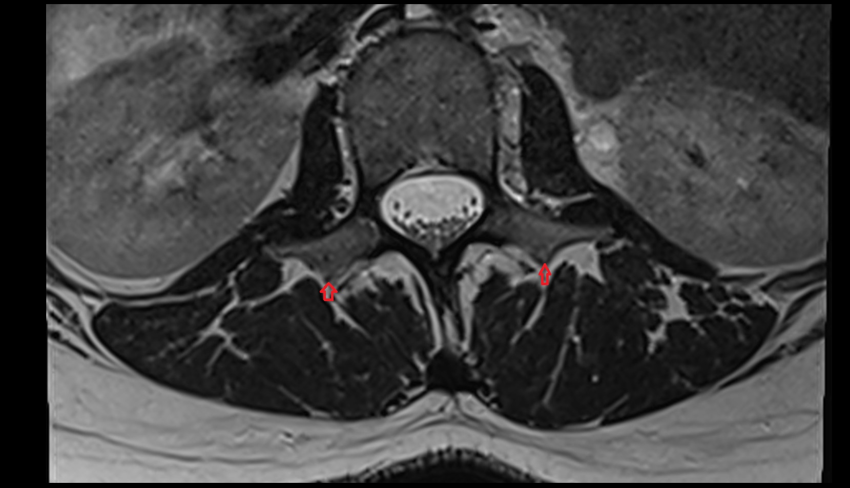 accessory process of vertebrae mri axial image
