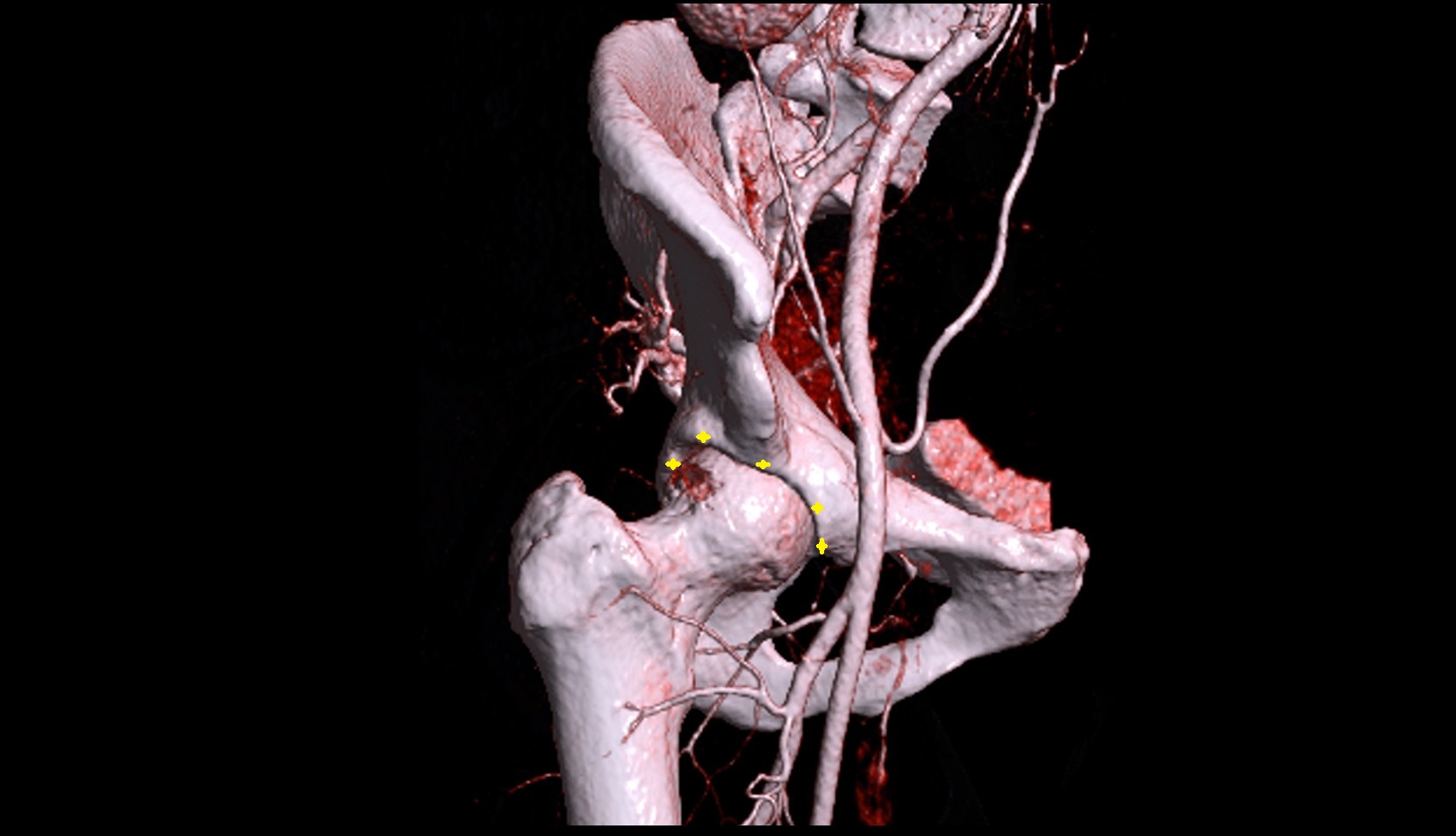 acetabular rim CT 3D VRT image