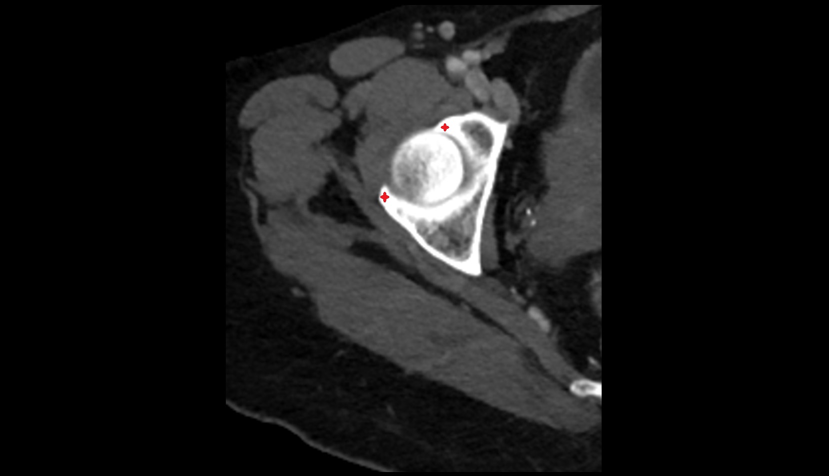 acetabular rim CT axial image