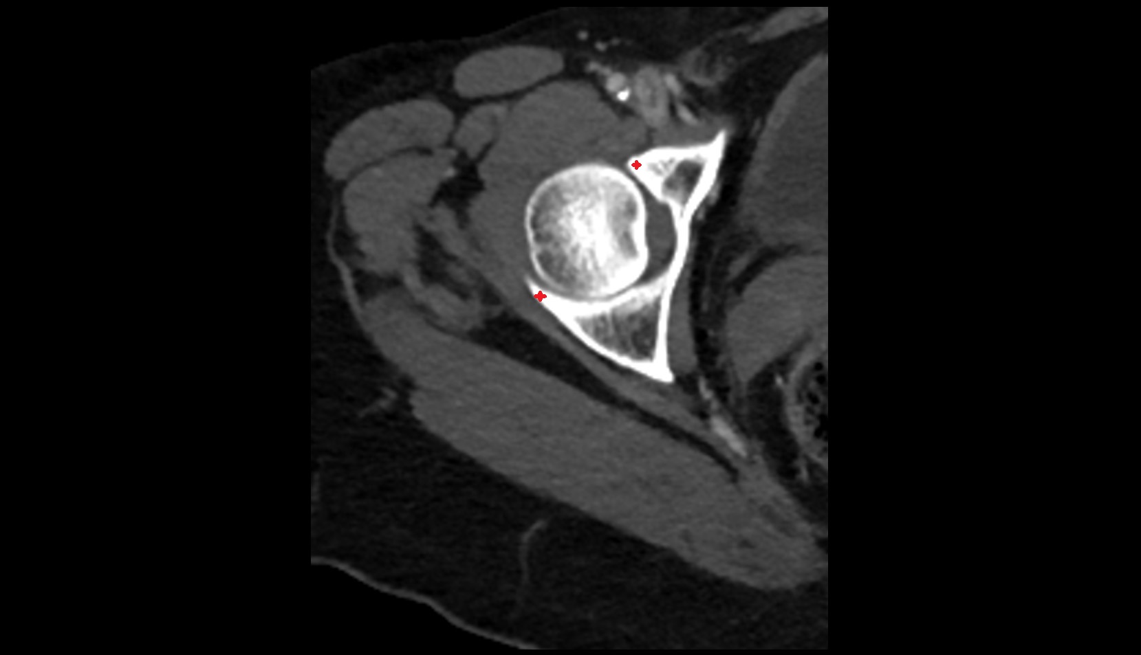 acetabular rim CT axial image 2