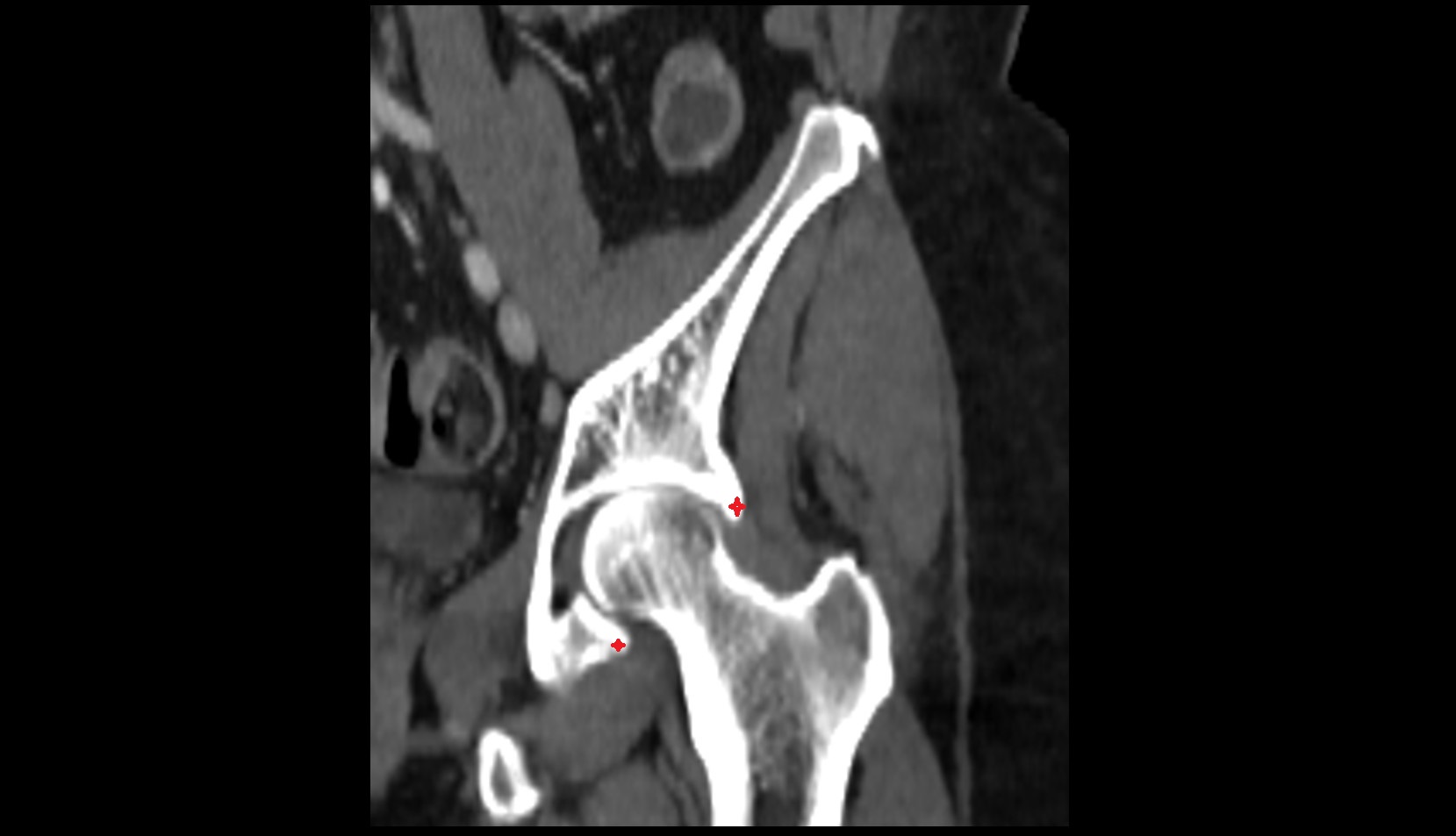 acetabular rim CT coronal image