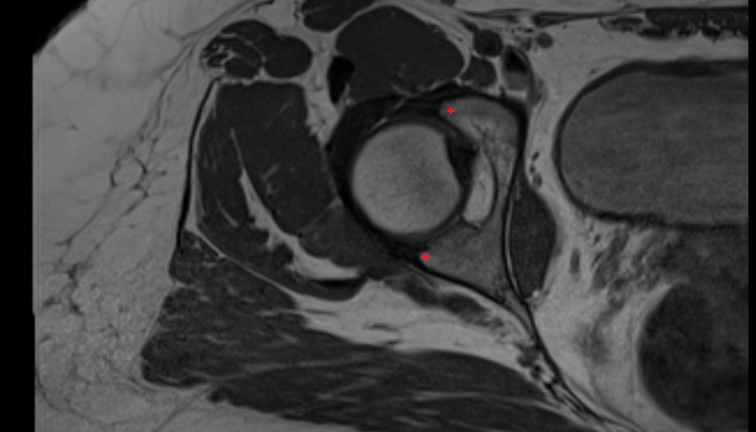 acetabular rim  MRI  axial  anatomy  image-img-00000-00000