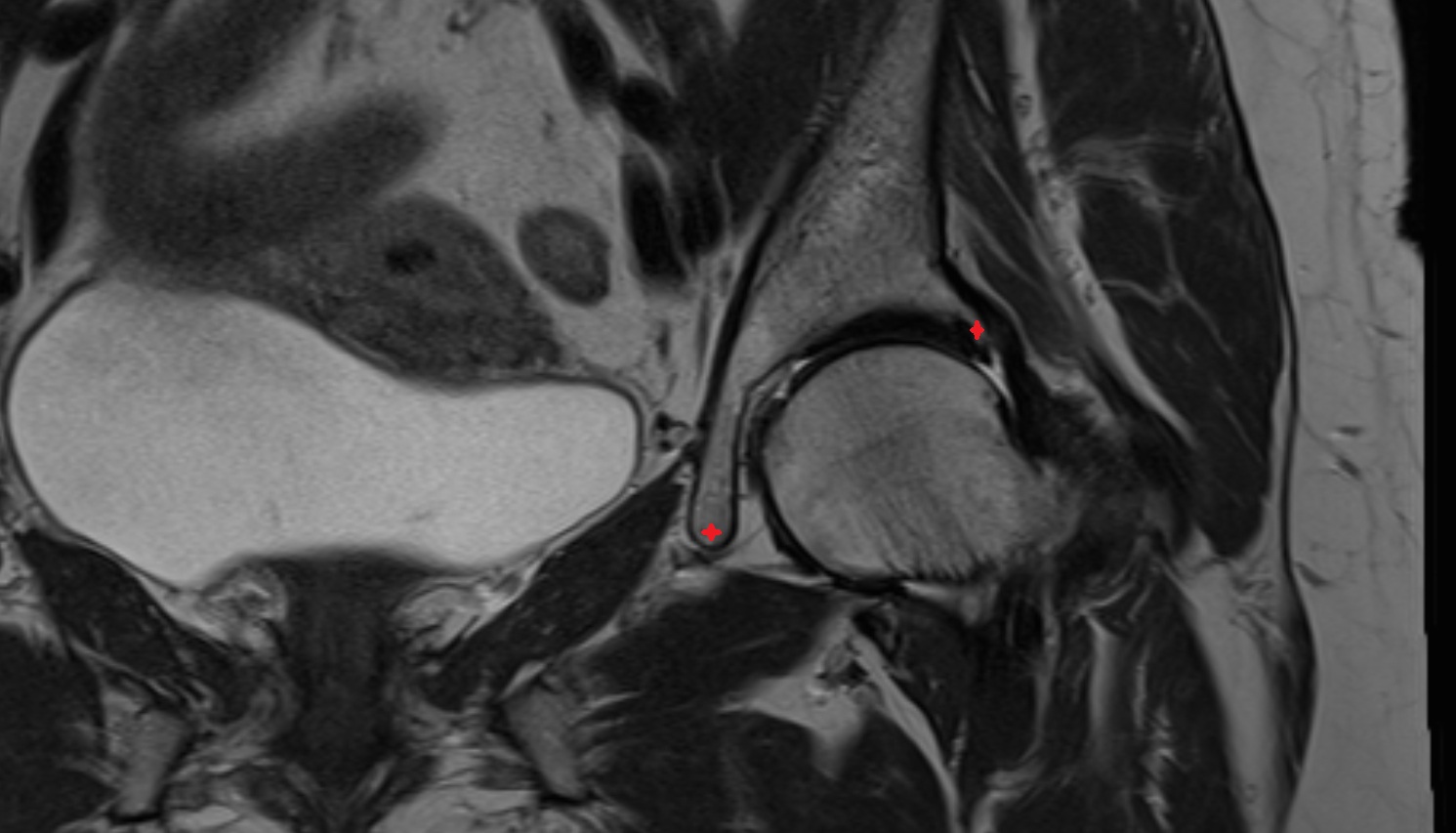 acetabular rim  MRI  coronal  anatomy  image-img-00000-00000