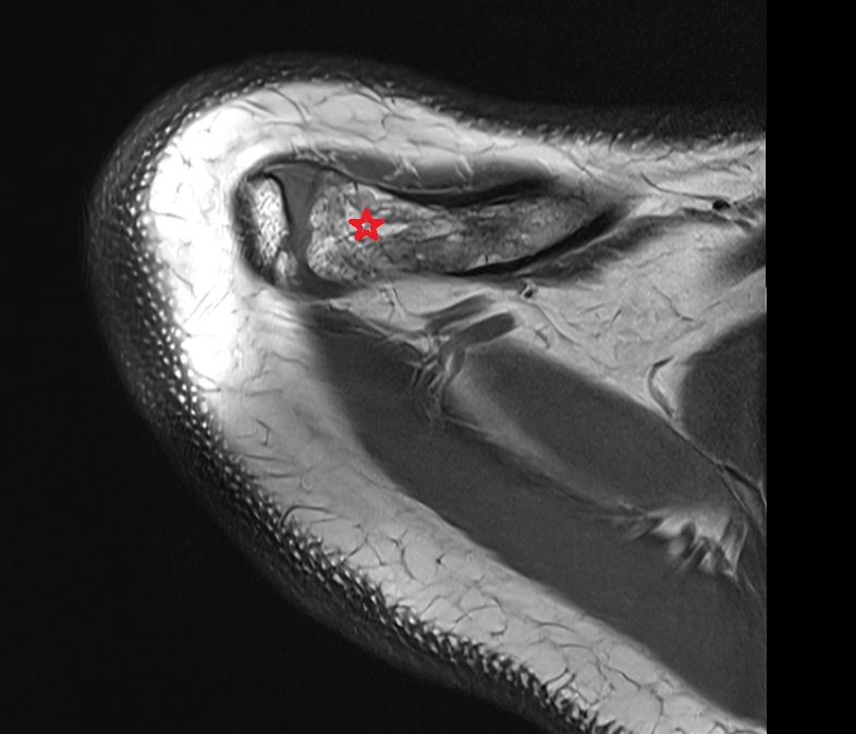 acromial end of clavicle anatomy MRI axial  image -img-00000-00000