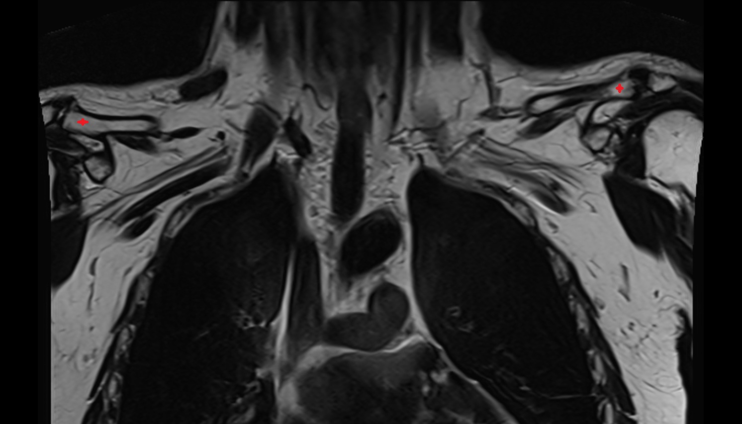 acromial end of clavicle anatomy MRI coronal  image -img-00000-00000