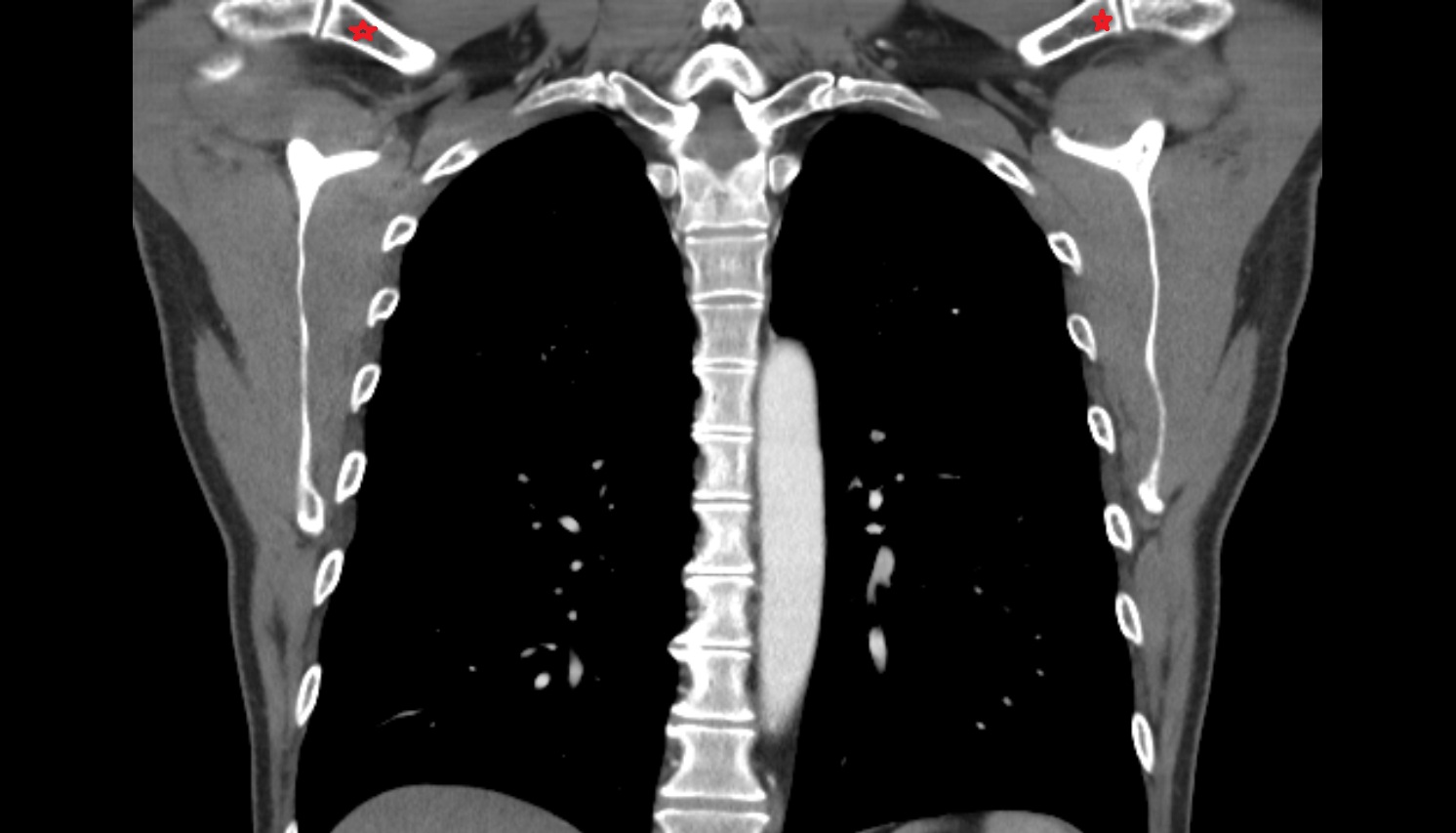 acromial end of clavicle anatomy ct coronal  image -img-00000-00000