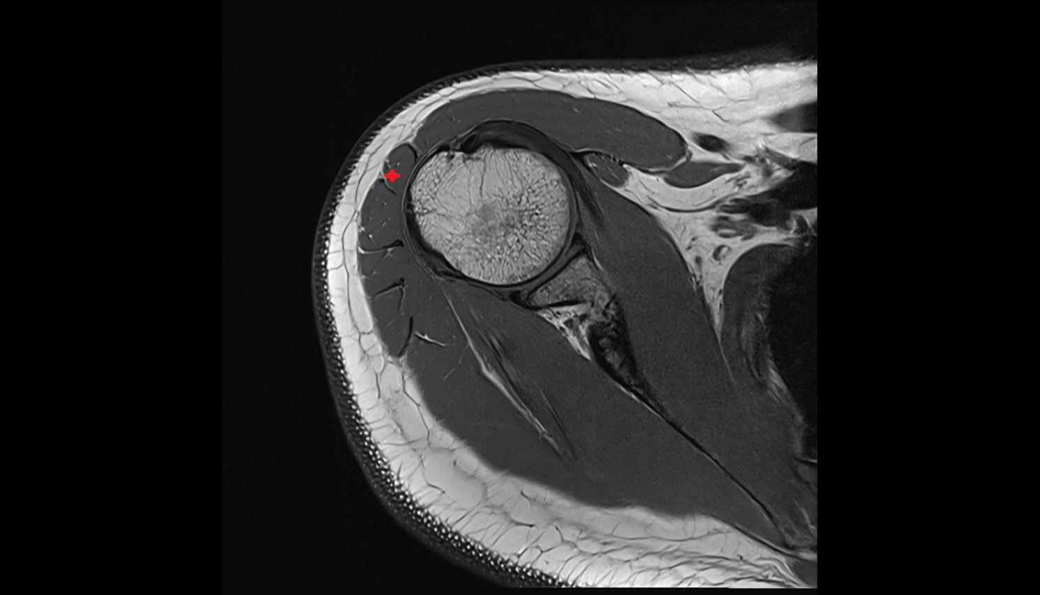acromial part of deltoid muscle  axial cross sectional anatomy 3T MRI AI enhanced radiology image-img-00000-00000