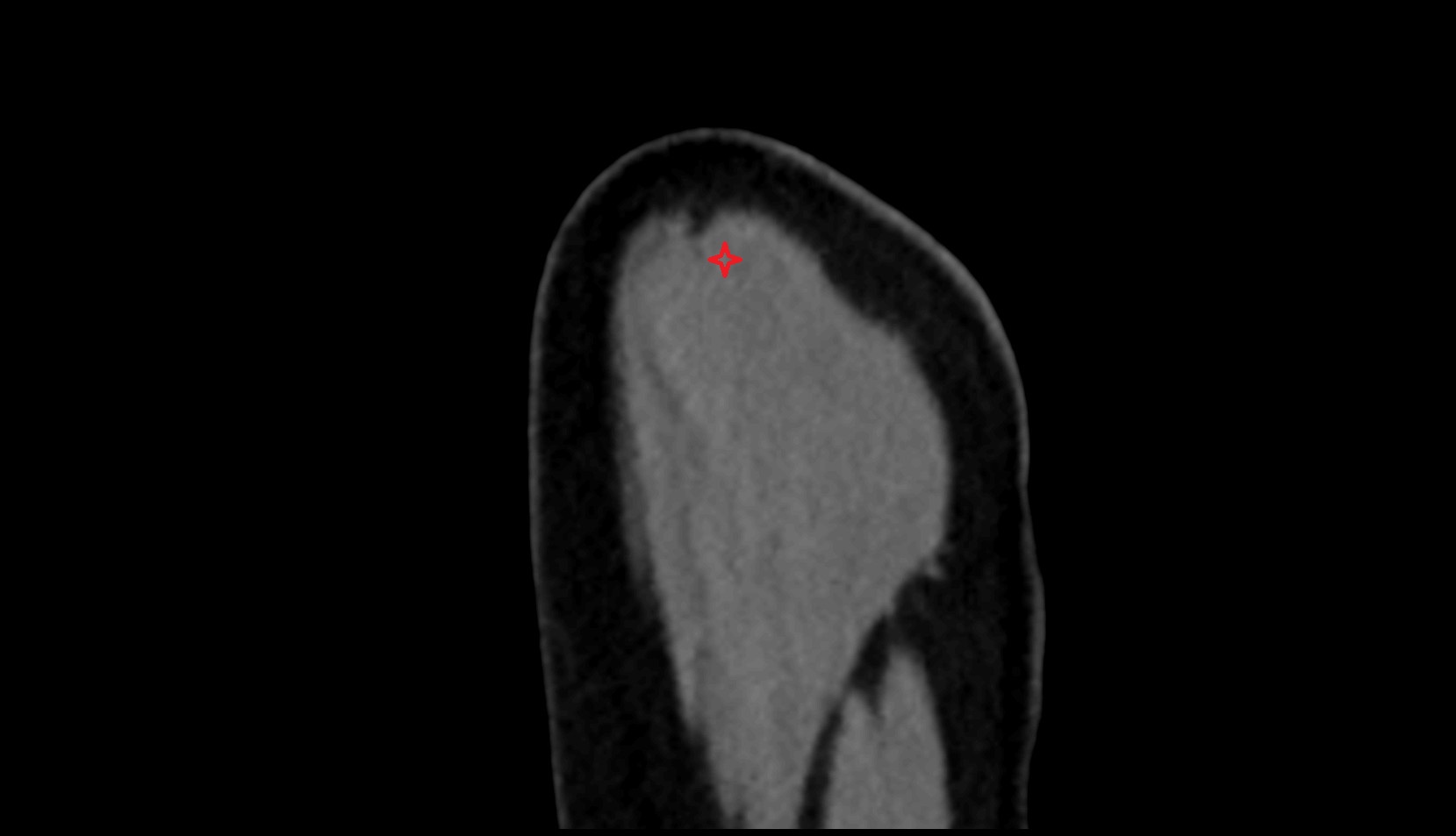 acromial part of deltoid muscle ct sag image