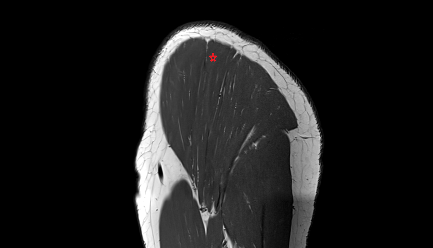 acromial part of deltoid muscle  sagittal cross sectional anatomy 3T MRI AI enhanced radiology image-img-00000-00000
