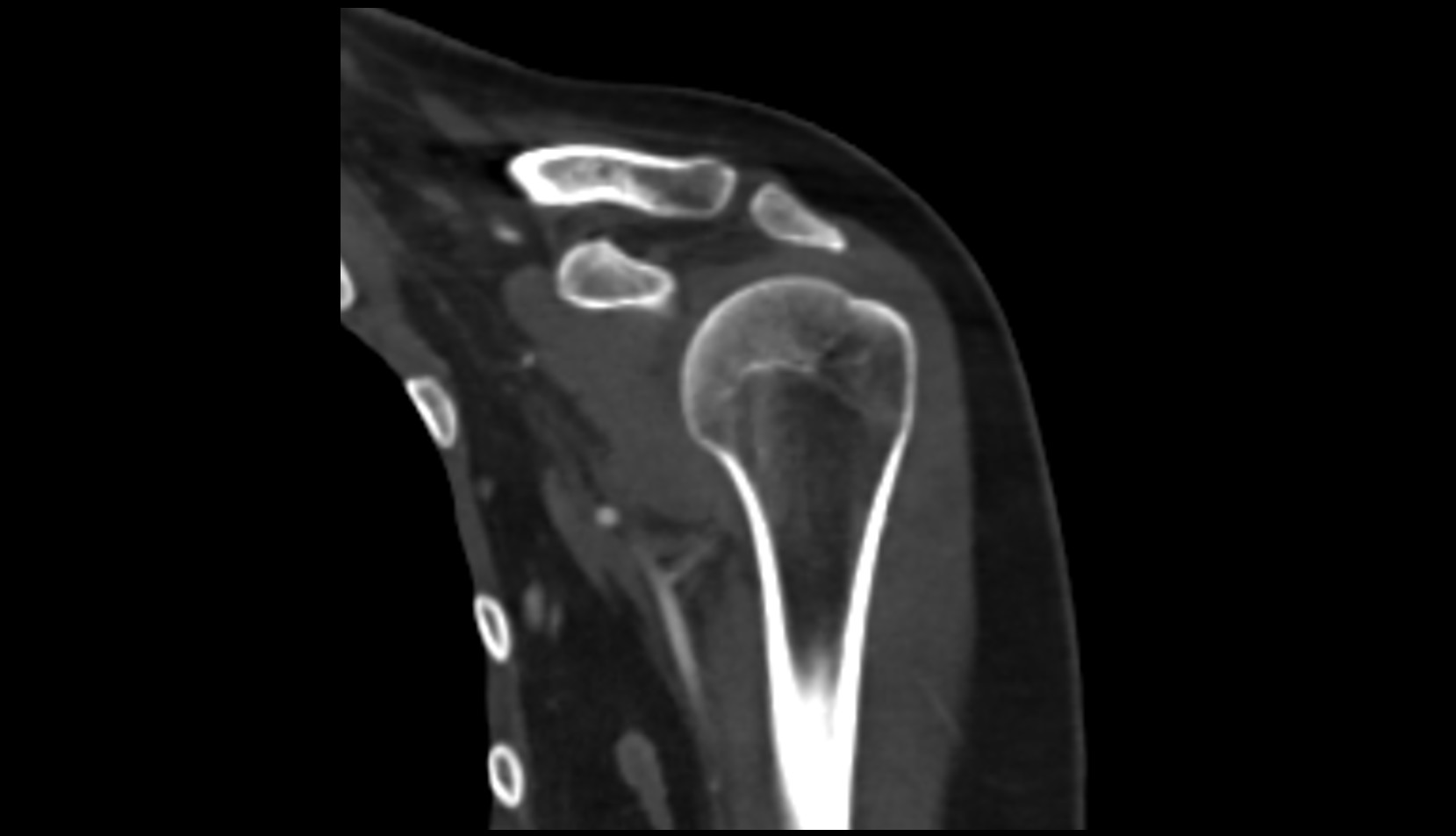 acromion process of scapula coronal ct image