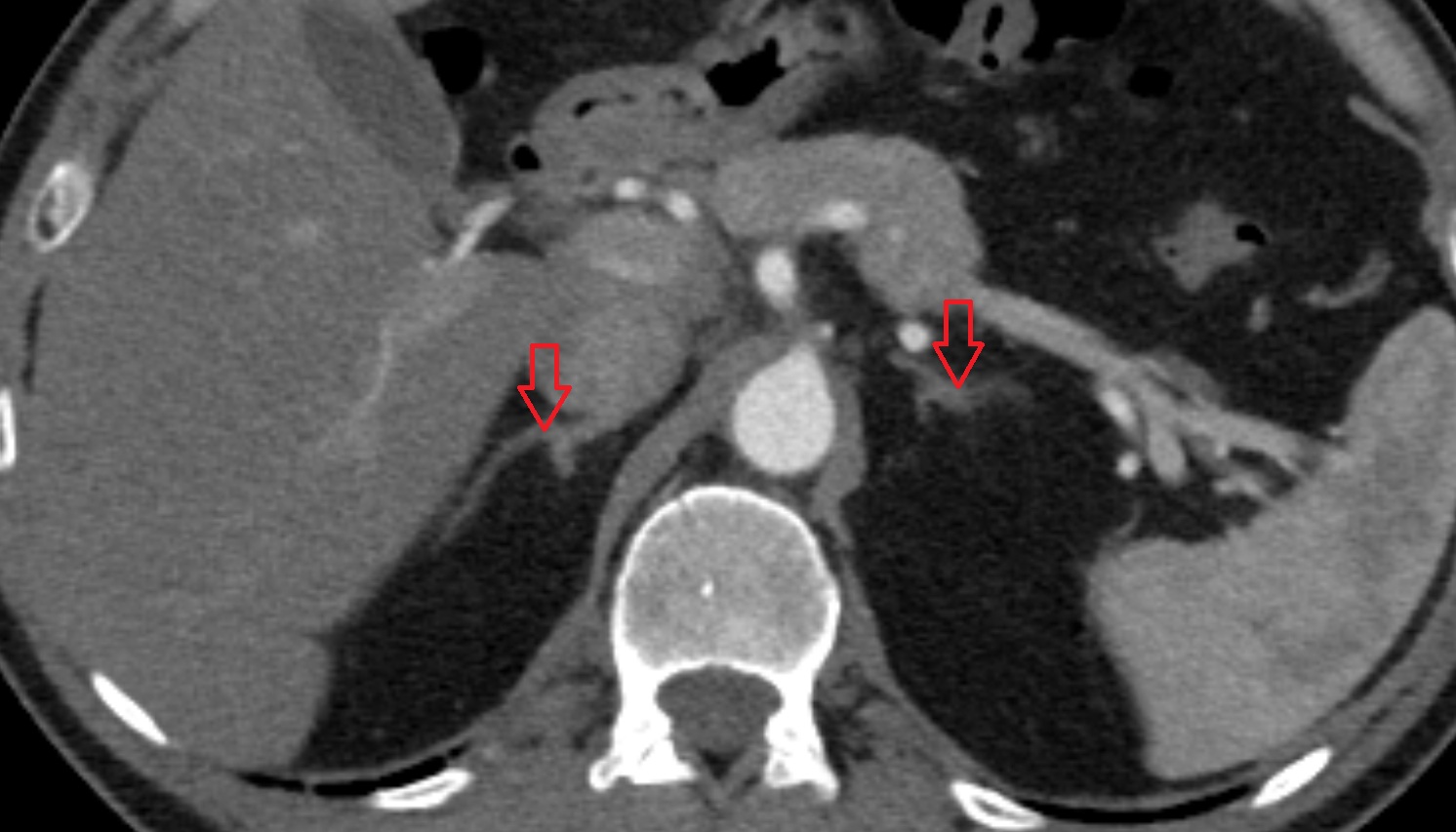 adrenal gland  anatomy CT axial  image -img-00000-00000