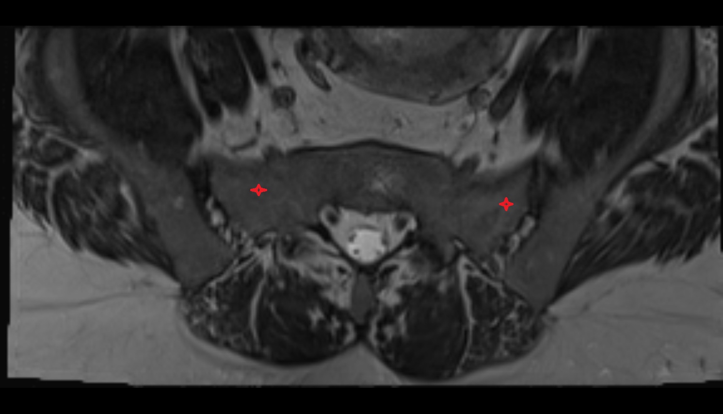 ala of sacrum  MRI axial anatomy  image -img-00000-00000