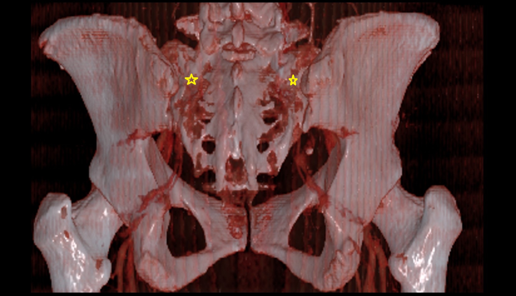 ala of sacrum ct 3d image