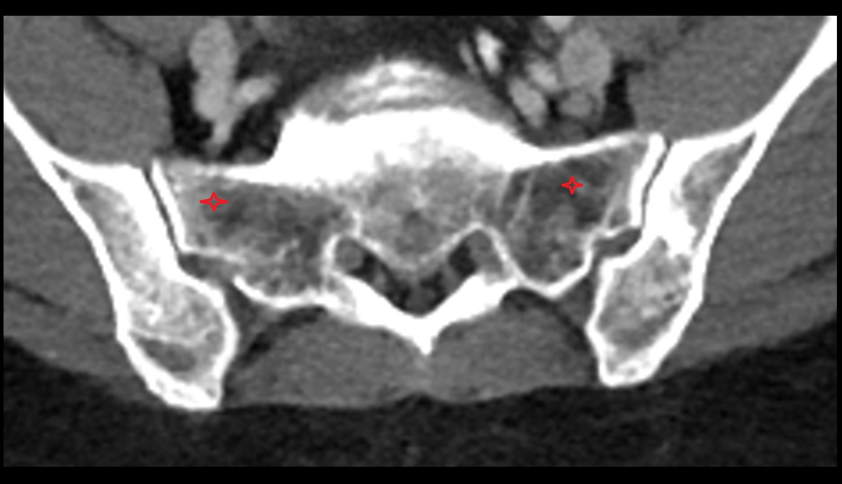 ala of sacrum ct  axial image