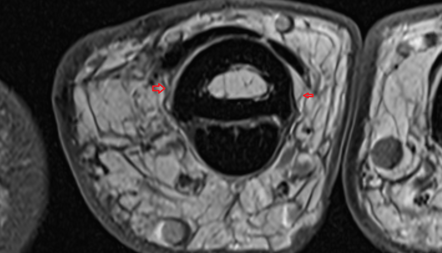 annular ligaments(annular pulleys) of the finger  MRI axial  image-img-00000-00000