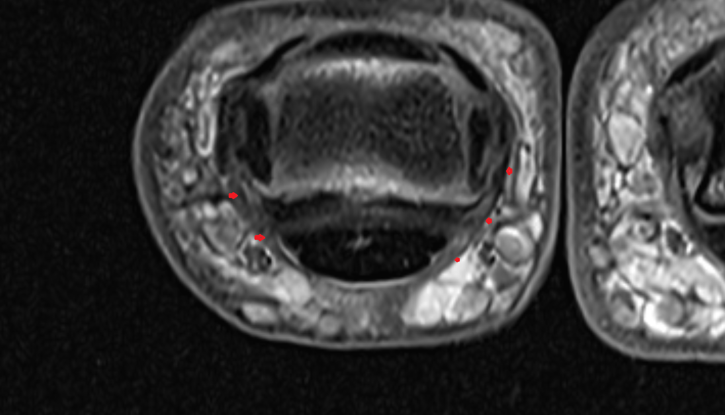 annular pulley  HAND  MRI CORONAL image-img-00000-00000