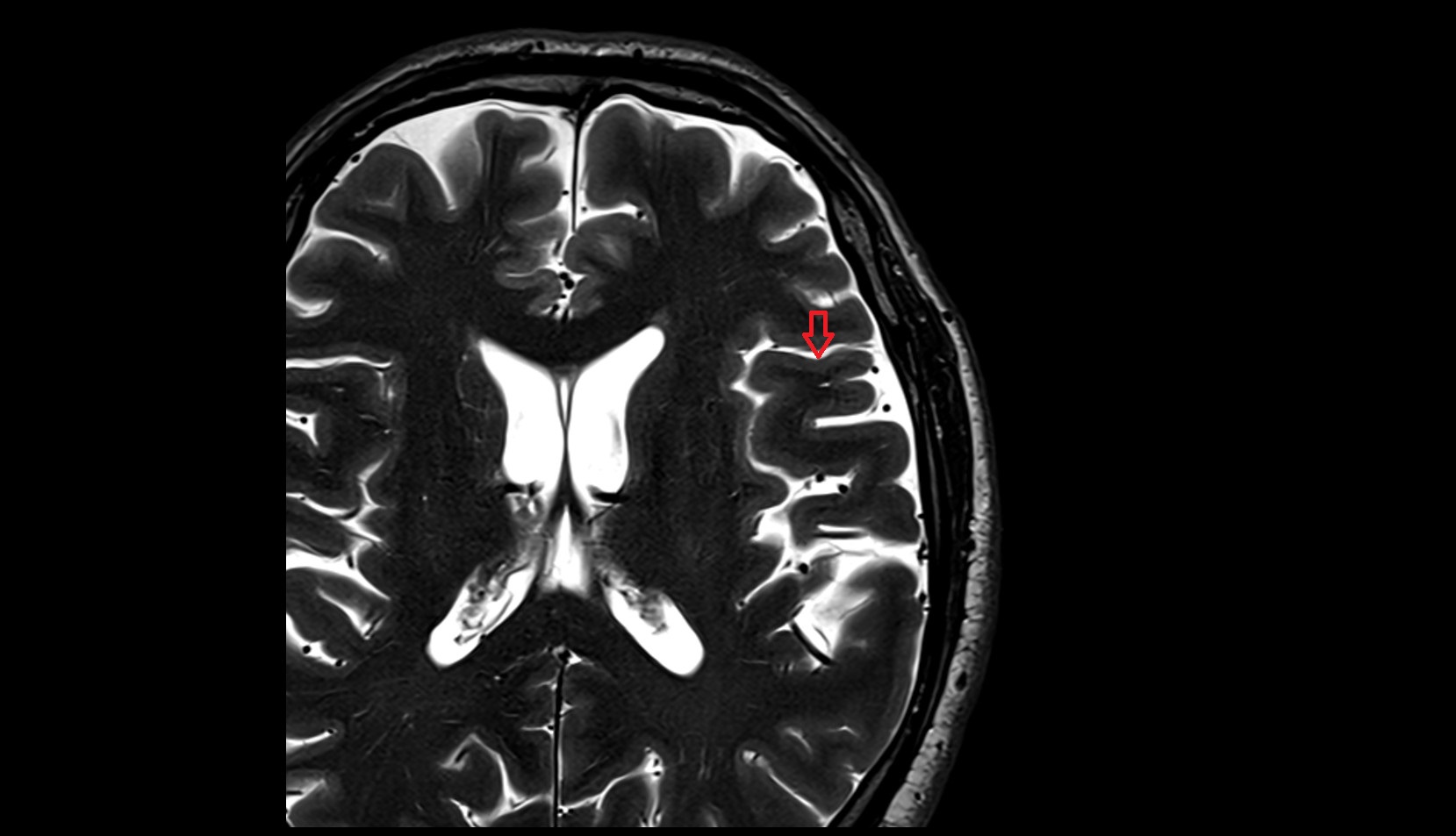 anterior ascending ramus  of Sylvian fissure MRI 3T axial image