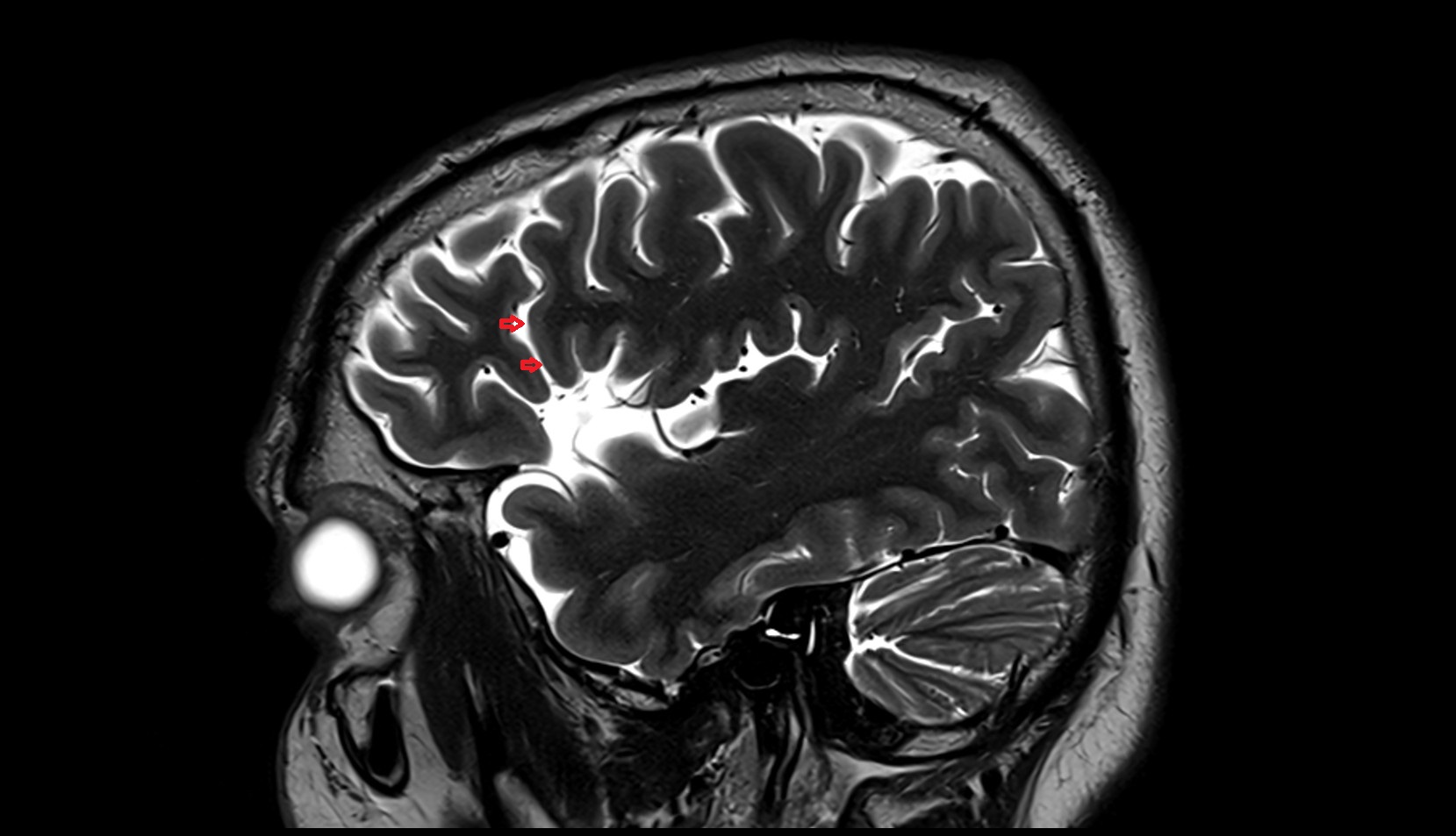 anterior ascending ramus  of Sylvian fissure MRI 3T sagittal  image