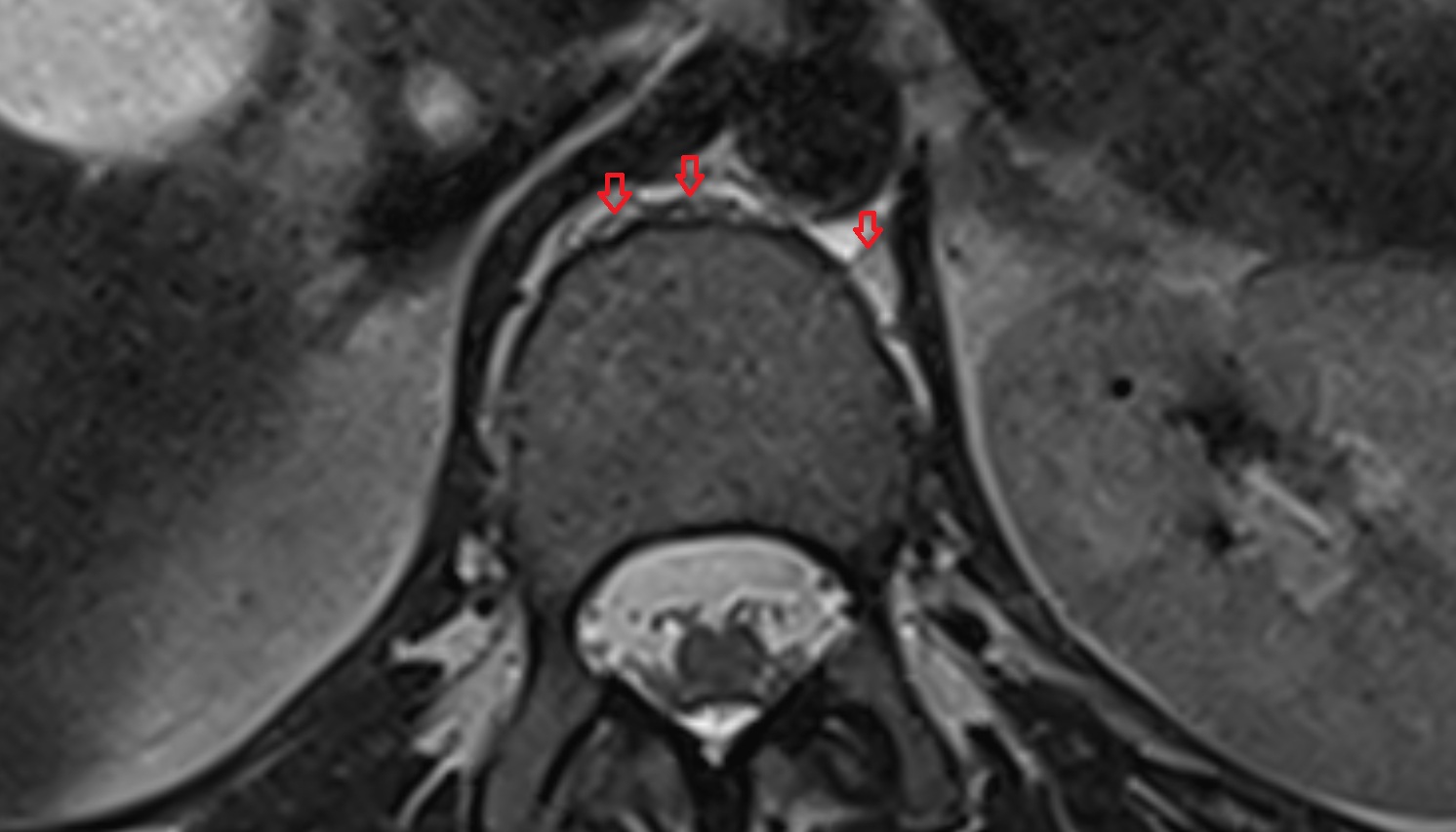 anterior external vertebral venous plexuses  mri axial  image -img-00000-00000
