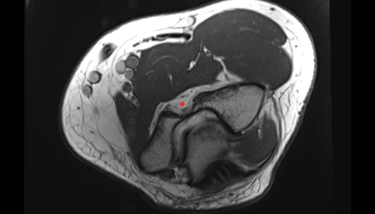 anterior fat pad of elbow joint axial cross sectional anatomy 3T MRI AI enhanced radiology image -img-00000-00000