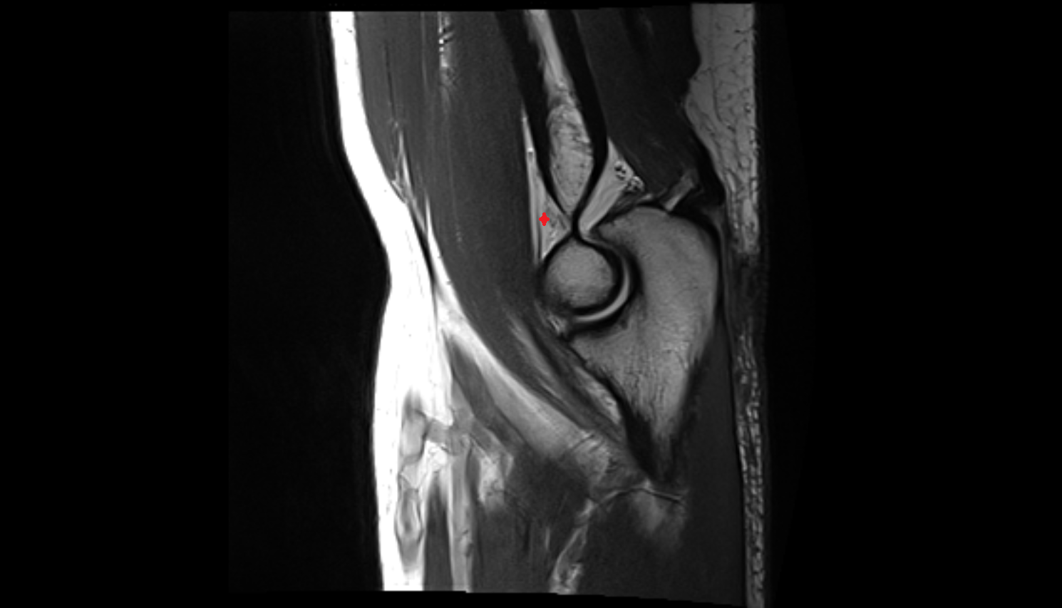 anterior fat pad of elbow joint sagl cross sectional anatomy 3T MRI AI enhanced radiology image -img-00000-00000