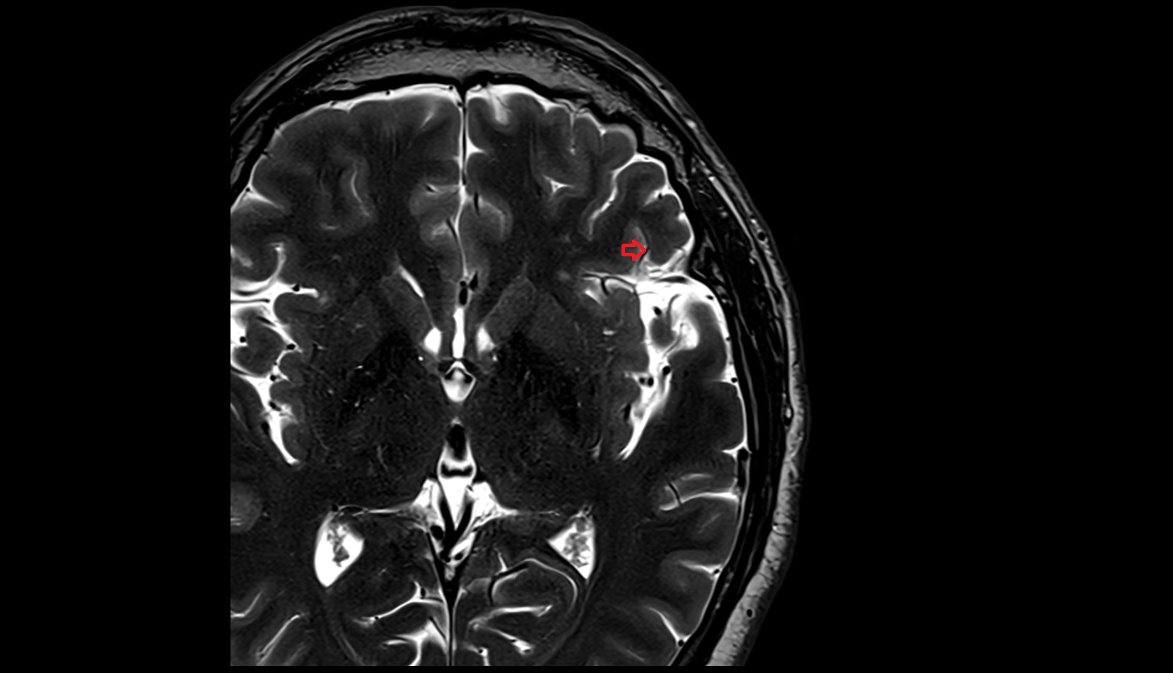 anterior horizontal ramus of Sylvian fissure MRI 3T axial image
