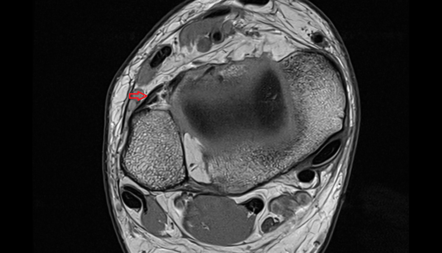 anterior inferior tibiofibular ligament axial cross sectional anatomy 3T MRI AI enhanced radiology image-img-00000-00000