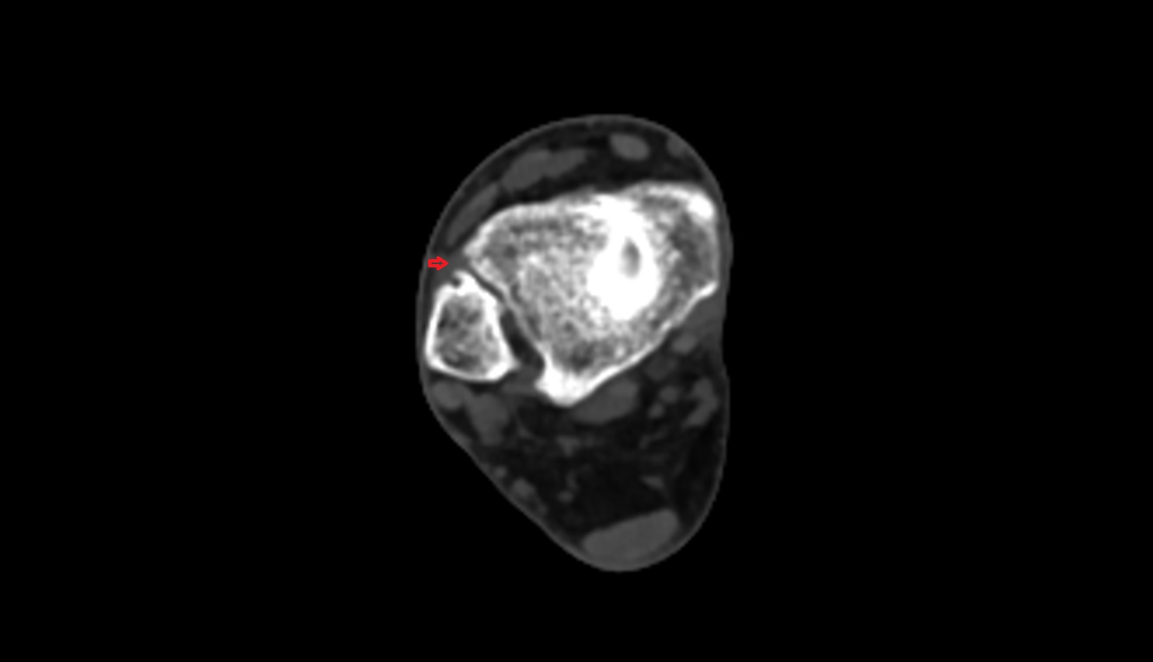 anterior inferior tibiofibular ligament ct axial image