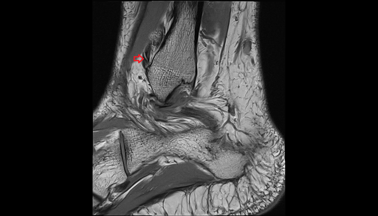 anterior inferior tibiofibular ligament  sag cross sectional anatomy 3T MRI AI enhanced radiology image-img-00000-00000_00001