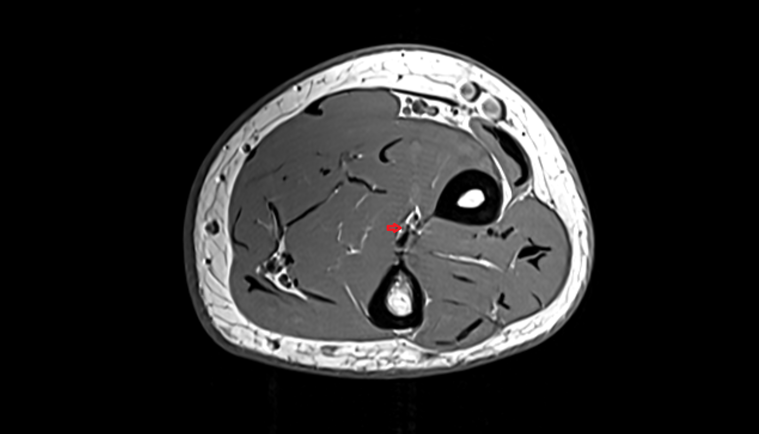 anterior interosseous artery axial cross sectional anatomy 3T MRI AI enhanced radiology image -img-00000-00000_00001