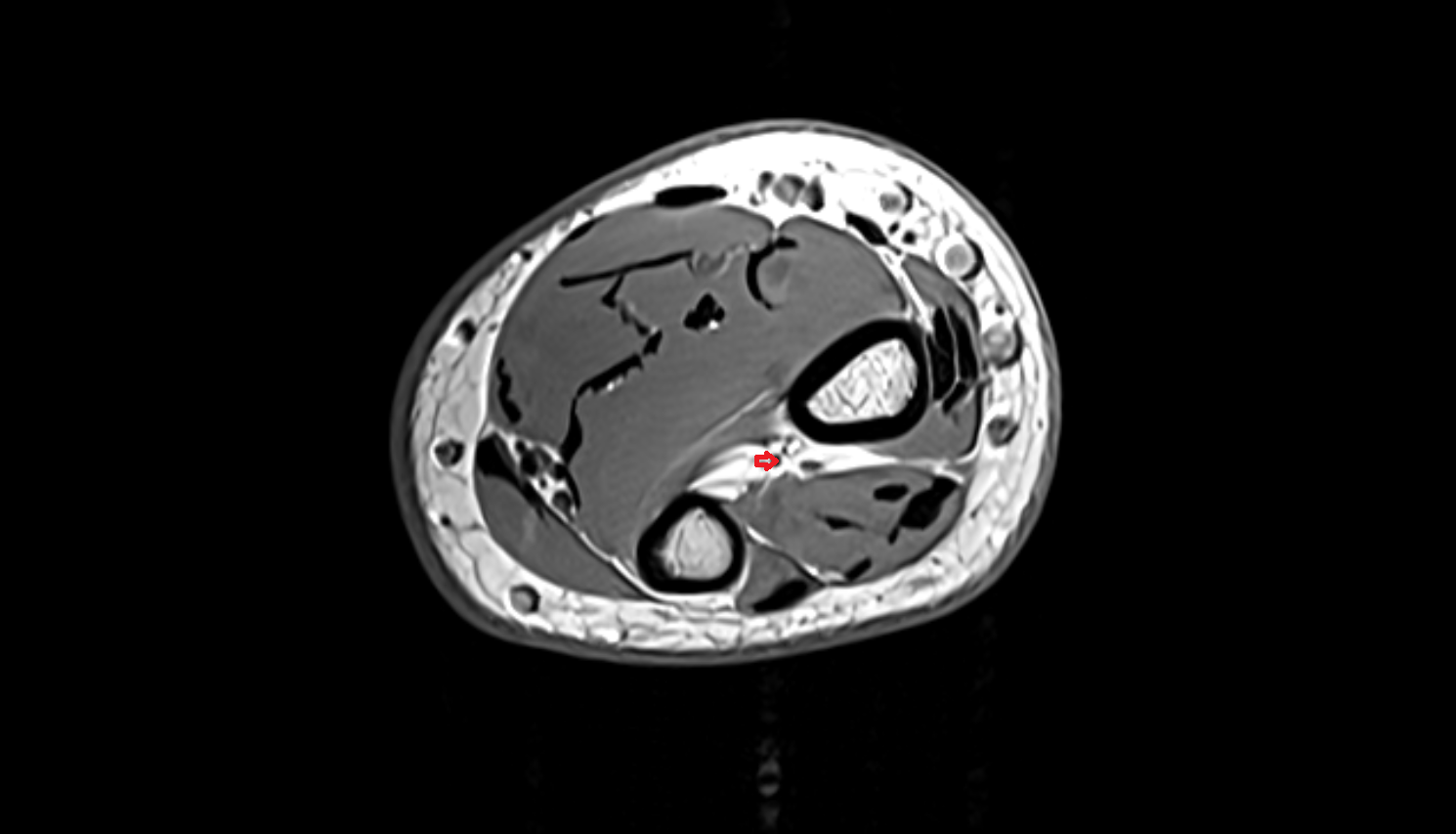 anterior interosseous artery axial cross sectional anatomy 3T MRI AI enhanced radiology image -img-00000-00000_00002