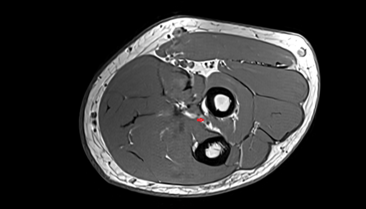 anterior interosseous veins  axial cross sectional anatomy 3T MRI AI enhanced radiology image -img-00000-00000