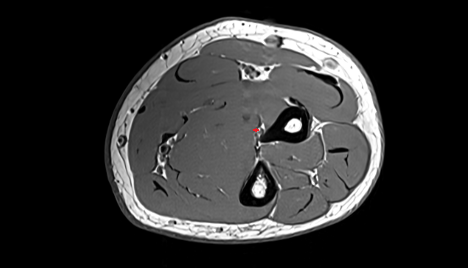 anterior interosseous veins  axial cross sectional anatomy 3T MRI AI enhanced radiology image -img-00000-00000_00001