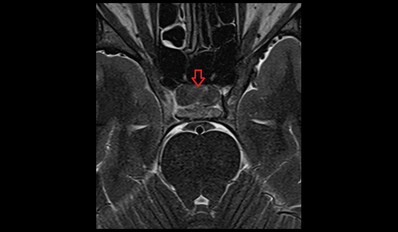 anterior lobe pituitary gland mri 3t axial image