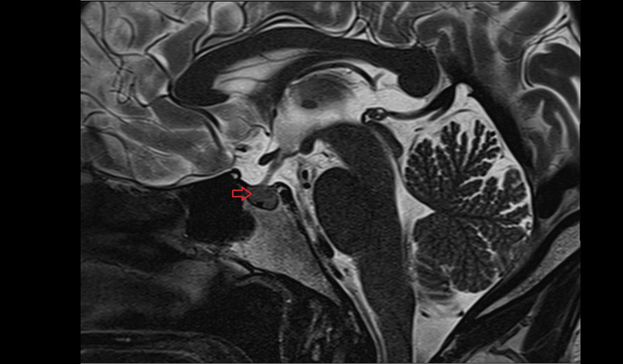 anterior lobe pituitary gland mri 3t sagittal image