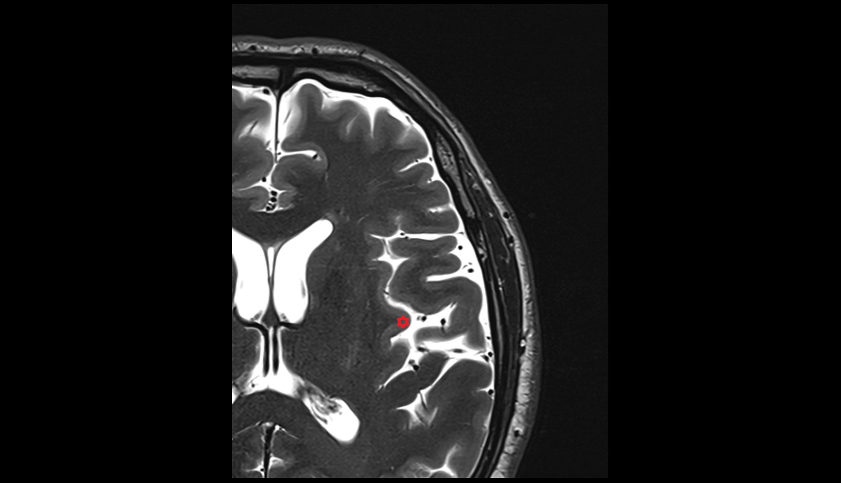 anterior long insular gyrus mri axial image
