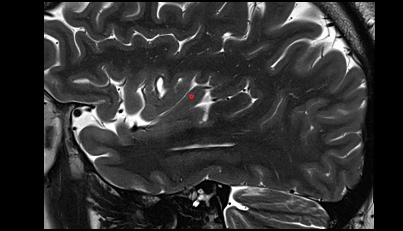 anterior long insular gyrus mri sagittal image