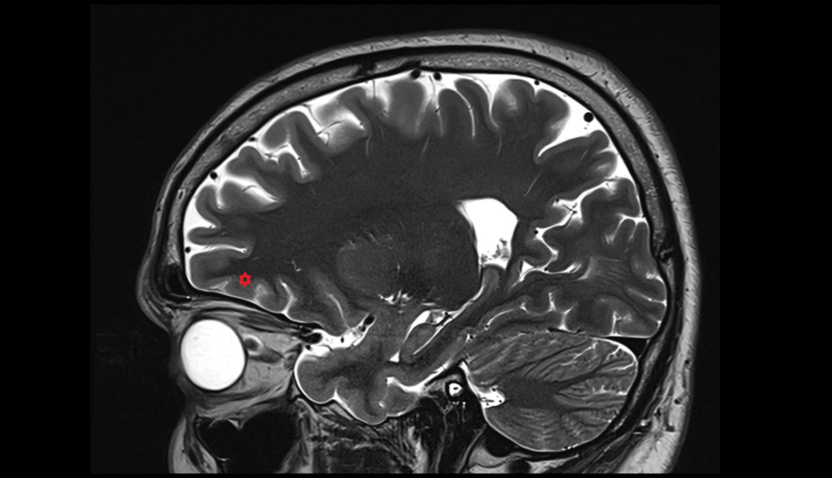 anterior orbital gyrus MRI 3T sagittal image