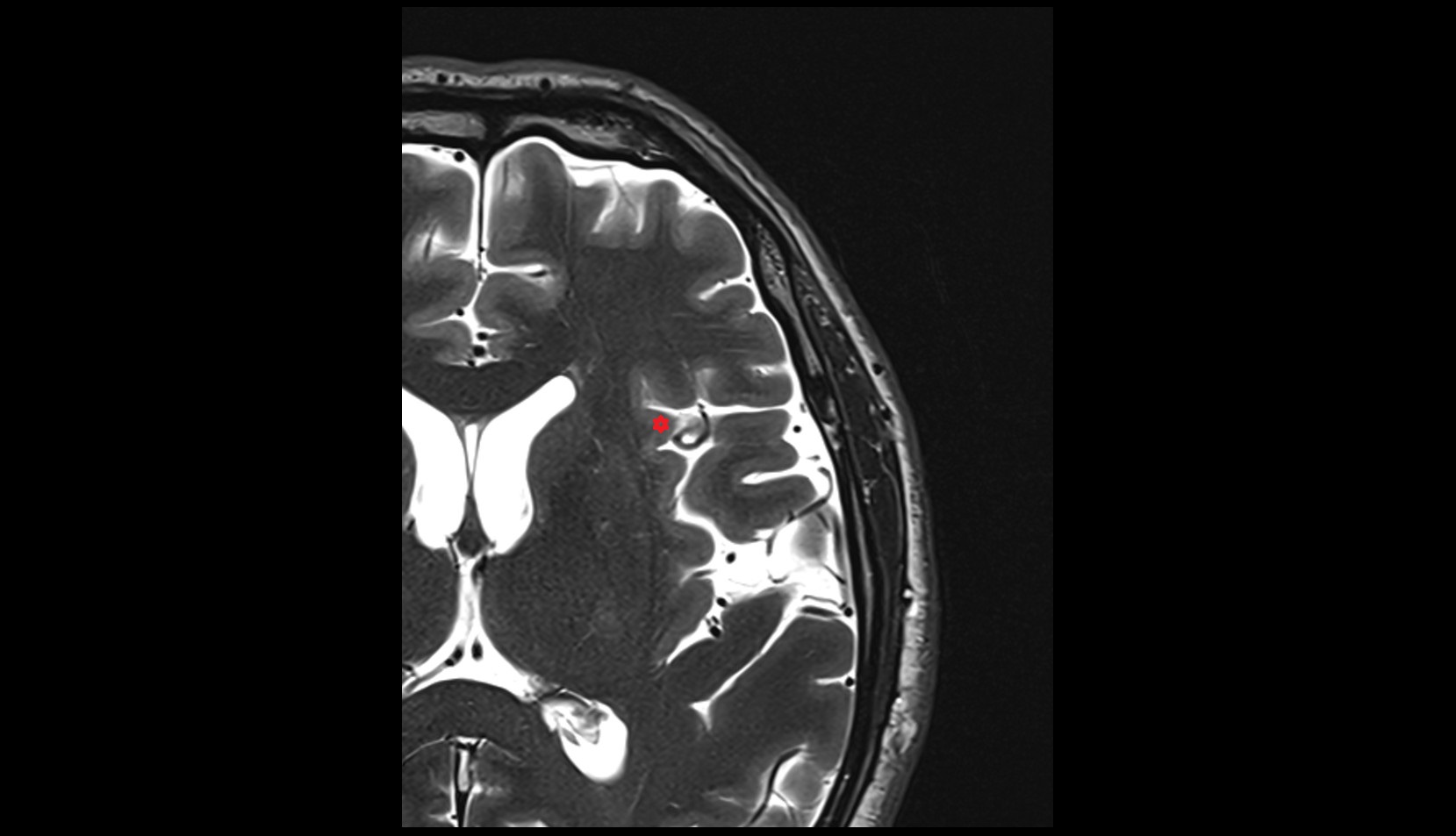 anterior short insular  gyrus mri 3t axial image