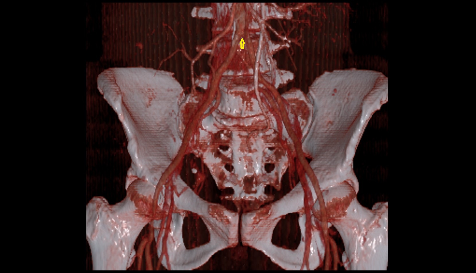 aortic bifurcation 3d