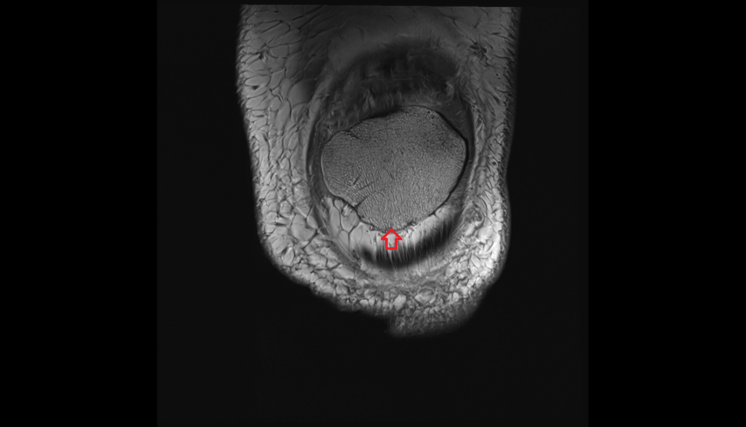 apex of patella coronal cross sectional anatomy 3T MRI AI enhanced  radiology  anatomy image-img-00000-00000