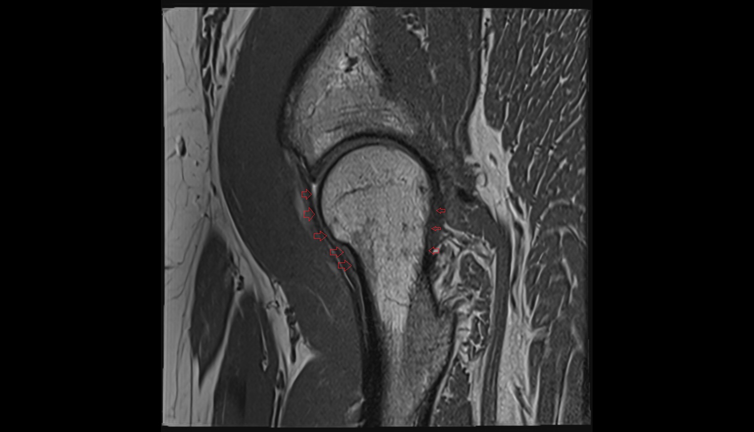 articular capsule of hip joint   MRI sag anatomy image-img-00000-00000_00001