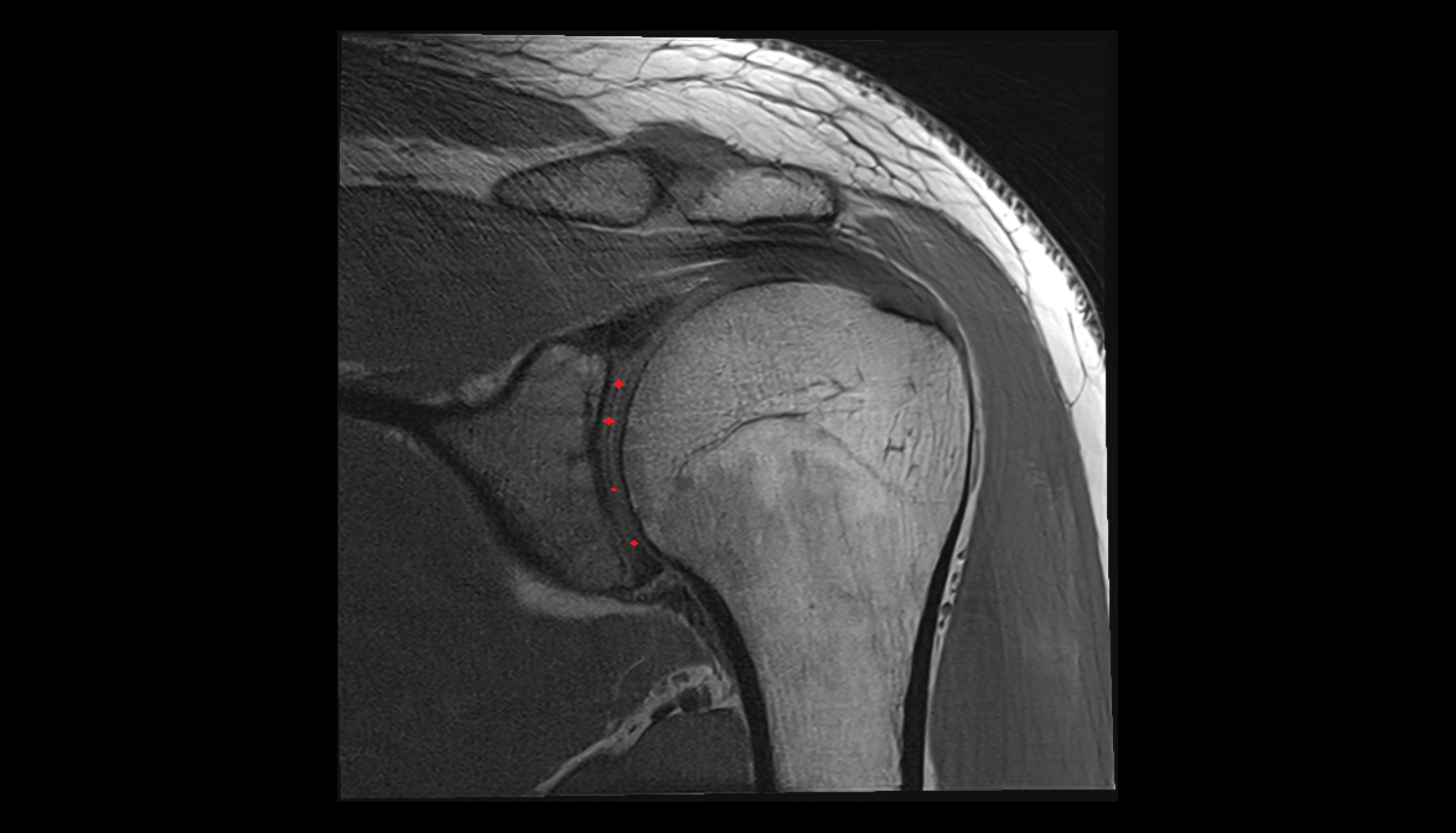 articular cartilage of glenoid fossa  CORONAL cross sectional anatomy 3T MRI AI enhanced radiology image-img-00000-00000