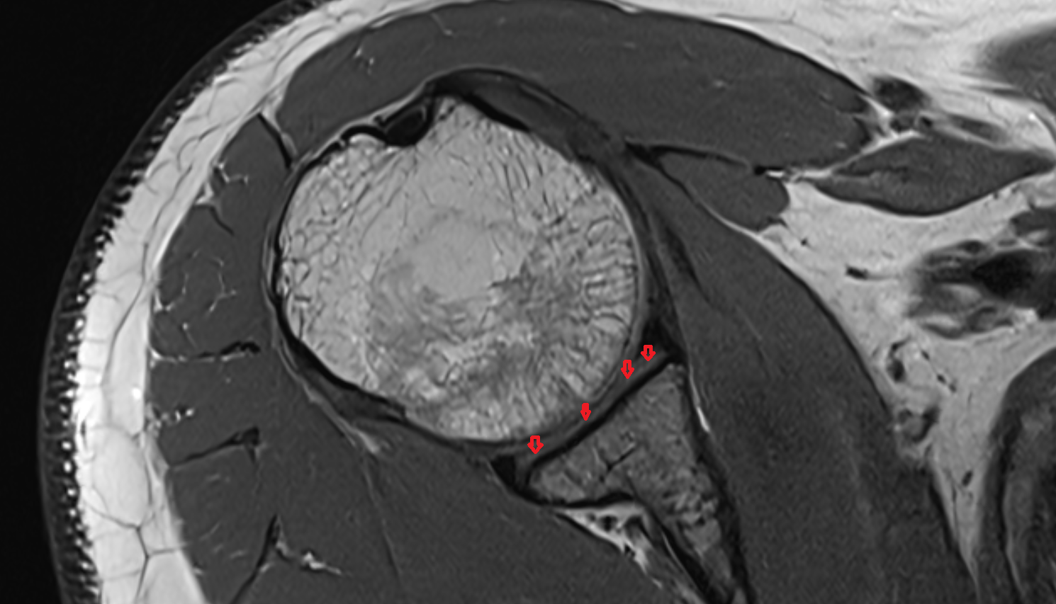 articular cartilage of glenoid fossa  axial cross sectional anatomy 3T MRI AI enhanced radiology image-img-00000-00000