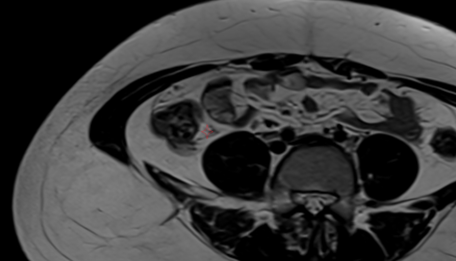 ascending mesocolon MRI  axial image anatomy  image -img-00000-00000