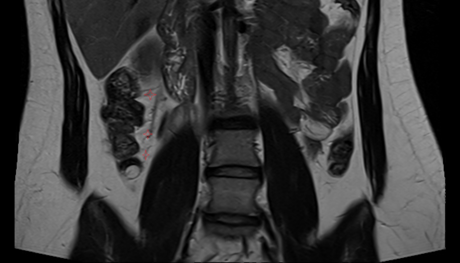 ascending mesocolon MRI  coronal image anatomy  image -img-00000-00000