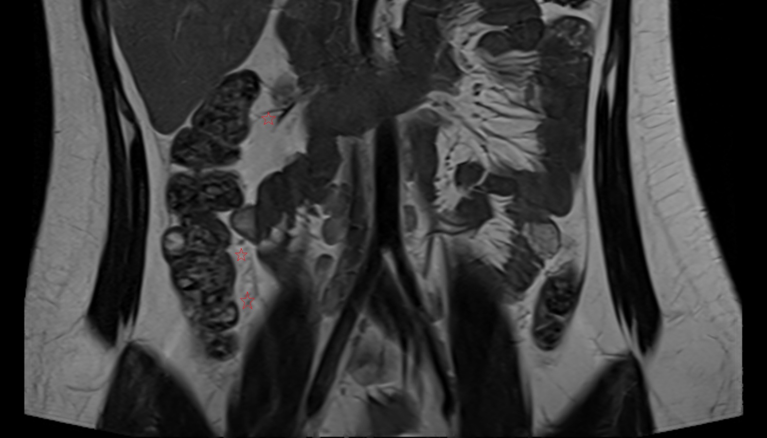 ascending mesocolon MRI  coronal image anatomy  image -img-00000-00000_00001