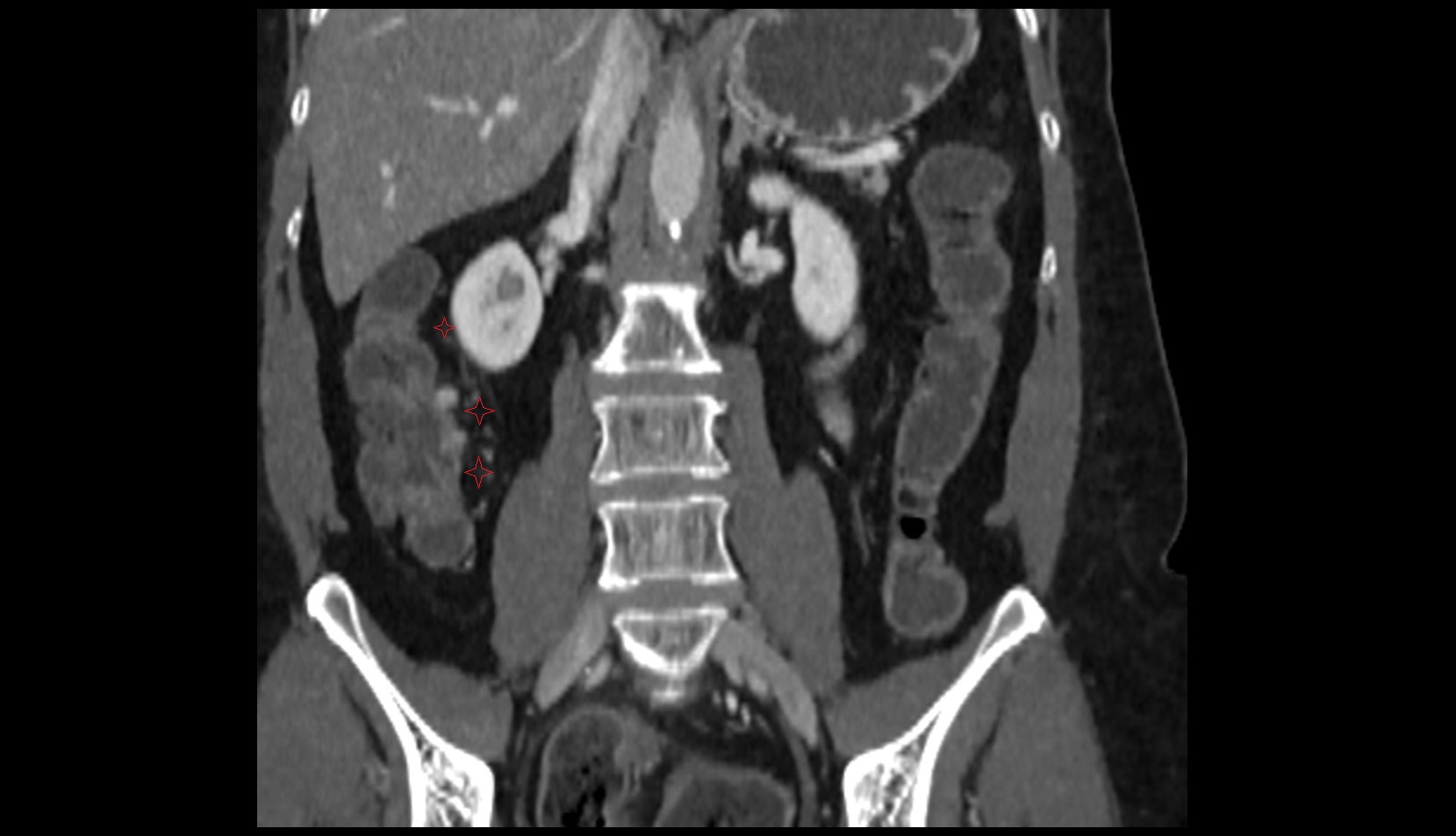 ascending mesocolon ct coronal image