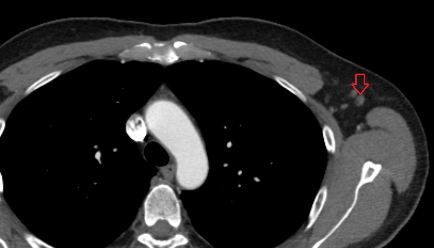 axillary lymph nodes  anatomy  CT axial image -img-00000-00000